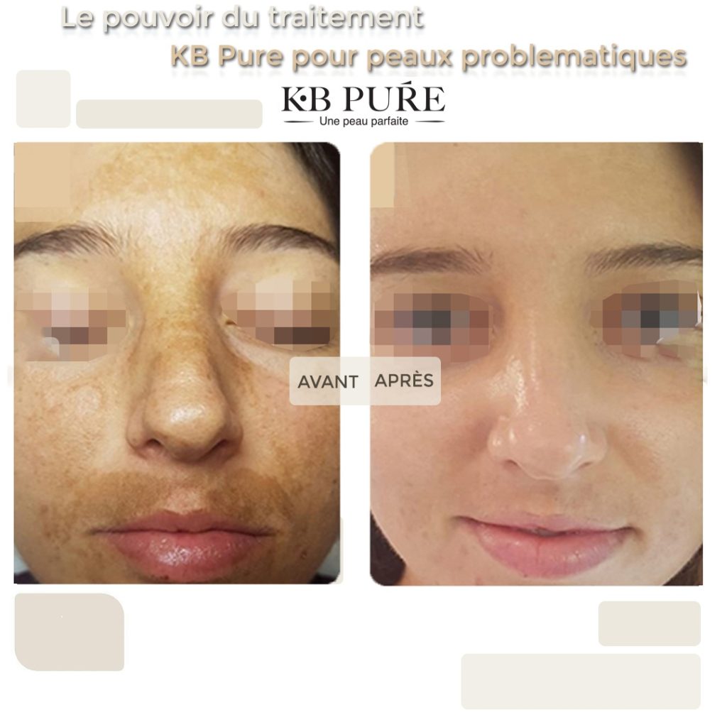 avant-apres